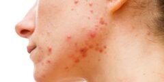 حب الشباب (acne)